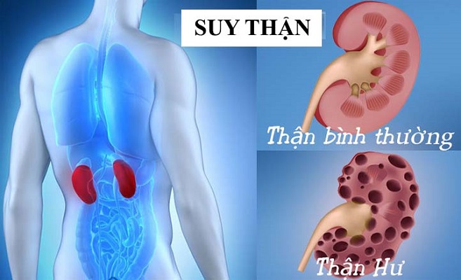 bệnh suy thận có thể gây ra huyết áp thấp